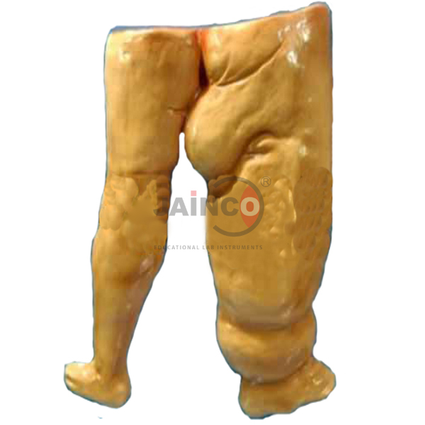 Elephantiasis Model