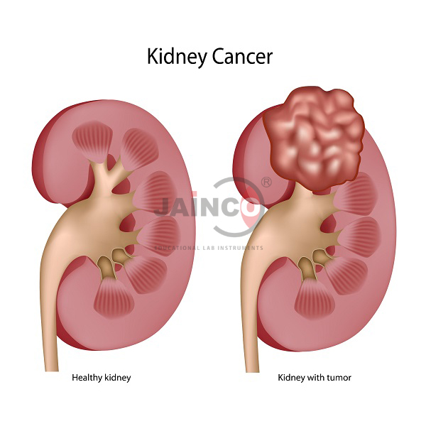 Wilms Tumor Model