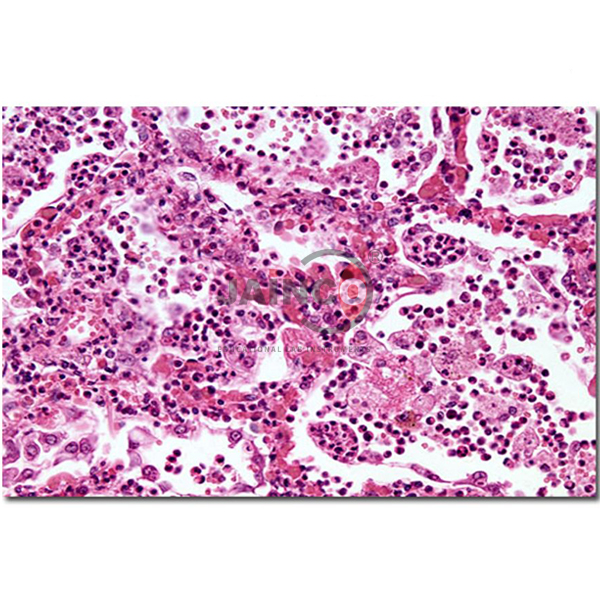 Lobar Pneumonia Grey Hepatisation Model