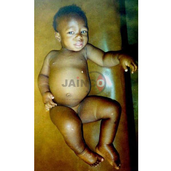Kwashiorkor Model
