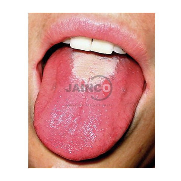 Angular Stomatitis Glossitis Model