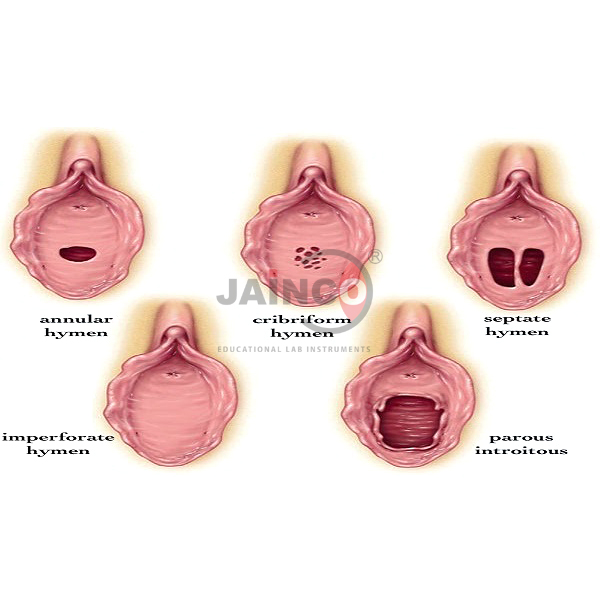 Hymen Annular Model