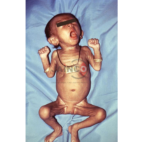 Tetanus of Baby Model